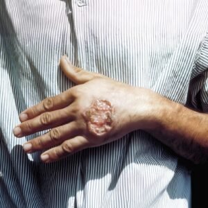 Salud confirma 12 casos de leishmaniasis en la región y refuerza la vigilancia preventiva